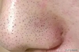 比痘痘更烦人的闭口来了，最有效的去闭口大法看过来图片