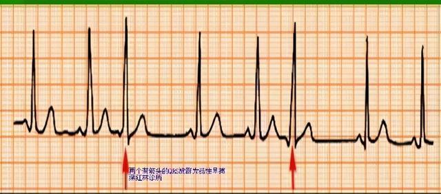 窦性心律什么意思（什么是窦性心律什么是早搏需做哪些检查要治疗吗如何治）