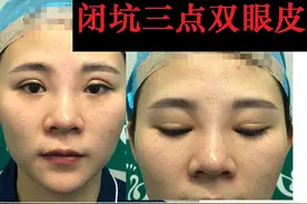 韩式微创三点双眼皮这么好，为什么竟然有医生不愿意做？图片