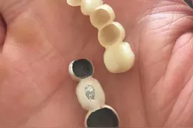 牙齿一颗成本究竟要多少！我们该去哪里做牙齿修复呢？图片