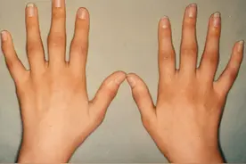 手指肿痛僵硬、有结节，预示着什么疾病？或是常见的这6种病因图片