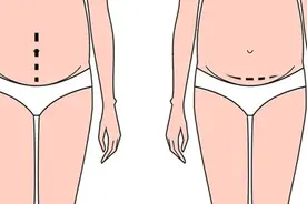 剖宫产，究竟是横切口还是竖切口更好？图片