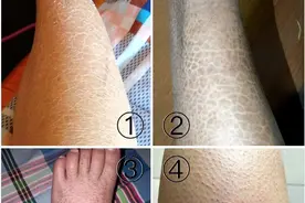 为什么气候湿润的南方也有很多鱼鳞病朋友？鱼鳞皮肤可以去南方吗图片