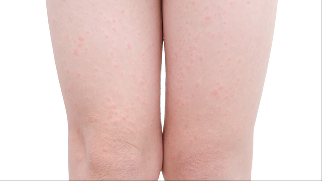 鸡皮肤可以永久去掉吗