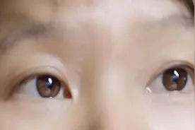 去除汗管瘤，下决心要激光图片