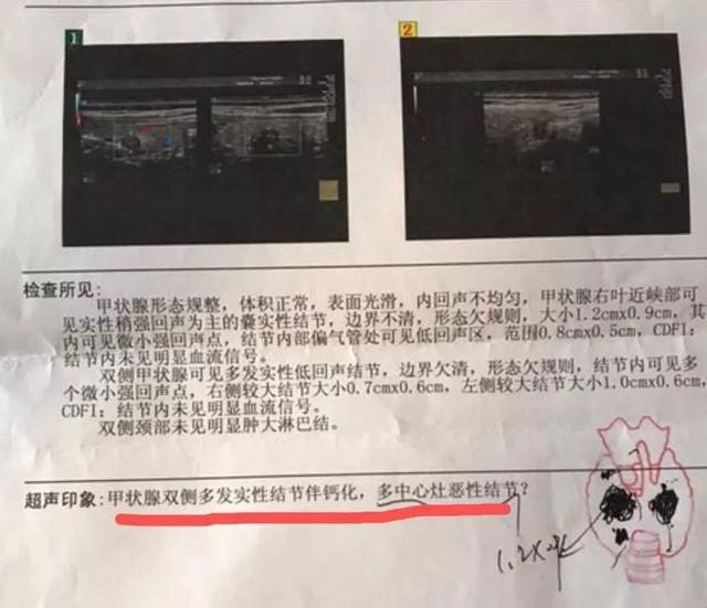 甲状腺结节一二三四级区别 2026年甲状腺结节一二三四级区别大吗