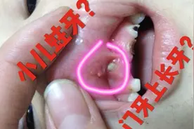 五岁宝宝蛀牙的门牙上又长了个牙，怎么回事呢？猜猜口腔门诊咋说视频封面