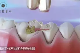 拔蛀牙瞬间有多痛？3D动画展示全过程，隔着屏幕都害怕了视频封面