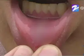 出车祸伤了三颗牙  两万元费用太高了？视频封面