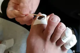 年轻顾客五个脚指头三个灰指甲  包药治疗视频封面