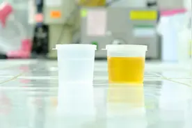 尿素偏高说明肾功能不全吗？哪些原因会导致尿酸高？医生告诉你视频封面