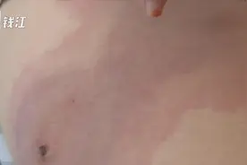 女孩大腿红肿一大片 医院一查被蜘蛛咬伤的视频封面