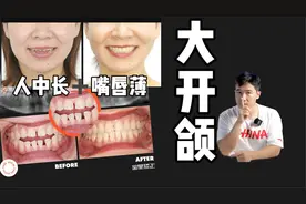 36岁长人中正畸案例，解除5-6mm大开颌，矫正后侧貌惊艳！视频封面