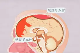 年轻人请注意！身体出现这些症状当心是脑出血前兆视频封面