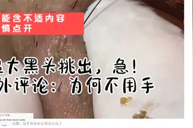 【解压】超大黑头跳出！老外评论：为何不用手视频封面