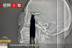 装修工作业出意外  医生紧急手术脑中“拔钉”视频封面