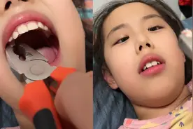 妈妈用老虎钳给女儿拔乳牙，妈妈：女儿主动要求，试一下就掉了视频封面
