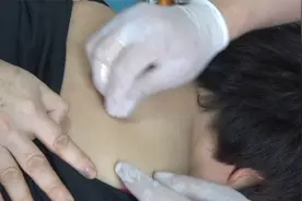 保定非遗-顿氏挑羊毛疔，顿俊卿现场挑治，颈椎引起的手指发麻视频封面