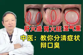 口臭主要就是，肝火旺、胃火旺和湿气重，中医教你辩口臭视频封面