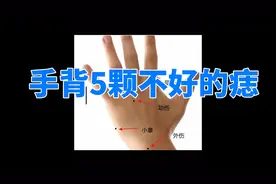 手背5颗不好的痣，千万要点掉！