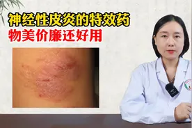 神经性皮炎的特效药！物美价廉还好用视频封面