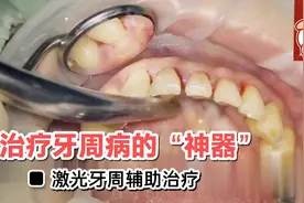 治疗牙周病的“神器”来了——激光牙周辅助治疗，能否药到病除?视频封面