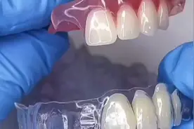 两种不一样的假牙，同样成本下你会选择哪一种，好看或者实用