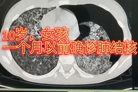 两肺弥漫性结节影，网格影，多发肺气囊，左侧气胸，左肺受压……视频封面