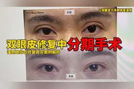 双眼皮修复中的分期手术是什么情况？潘贰眼综合修复真实案例解析视频封面