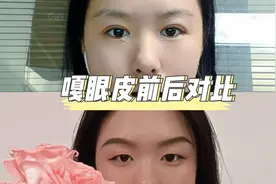 嘎眼皮第九天啦 单双眼皮前后对比