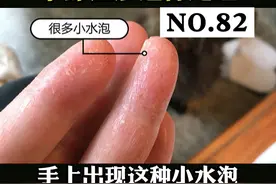 手上去水泡，脱皮瘙痒，反反复复，很烦人，这可能是#手部湿疹 
我们可以这样处理#湿疹 #健康 