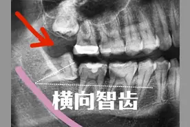 你的智齿也经常痛吗？ 看看国外牙医是怎么处理的 #智齿 #拔牙视频封面