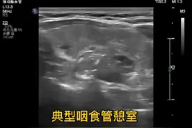 咽食管憩室超声及临床知识。#医学科普 #超声学习 #超声影像视频封面
