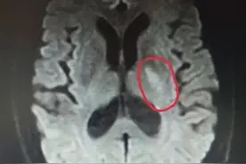 脑卒中后偏身肌张力过高怎么办？科学服用3种药物，改善肢体活动图片