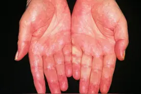 手掌发红是预示有肝病吗？图片