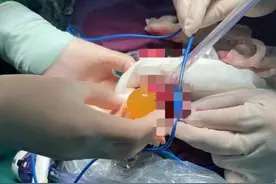 遇水膨大数百倍 1岁幼儿误吞“海洋宝宝”堵塞肠道，医生手术及时取出图片