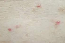 看又看不到，搓也够不着，后背上的痘，到底该怎么祛？图片