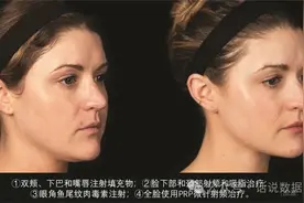 HIV新的传播途径，一种美容项目让多人感染艾滋病毒图片