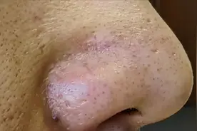 黑头，还有这么多花头！图片