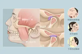 张不开嘴、腮帮子咔咔响？可能是颞下颌关节紊乱病图片