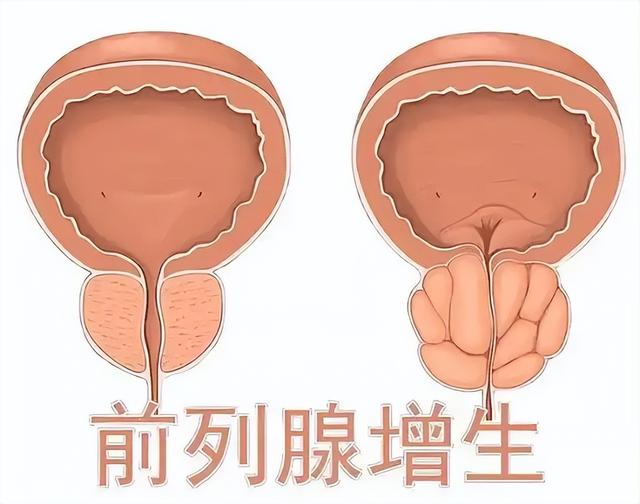 浙大研究：前列腺增生大量喝茶，用不了多久，身体或有6大变化