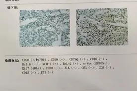 骨髓活检在白血病诊断中的作用和意义图片