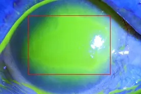 误把风油精当眼药水灼伤眼角膜，不慎误滴应立即用大量清水冲洗眼睛图片