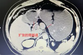 “肚子痛”竟是肠道血管“大堵车”！苏州专家团队多轮会诊助患者脱险图片