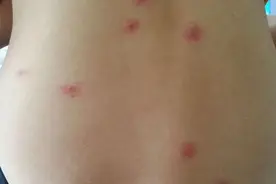 一个被蚊虫叮咬后，最快止痒、消肿的方法，你和娃都需要！图片