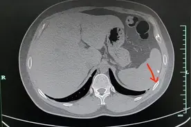 30岁男子咳嗽咳断2根肋骨，医生提醒图片