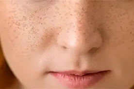 祛斑后反黑？该如何走出困境~图片