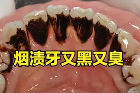 满嘴烟渍黢黑发臭？过来人支你几招！不洗牙也能立刻清除！图片