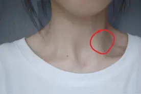 出现这些症状可能你淋巴结肿大：3个因素容易导致肿大，做好预防图片
