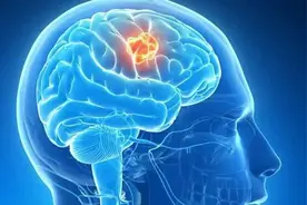 44岁女子突发脑癌，原因竟是吃了猪脑？很多人还把它当做宝！图片